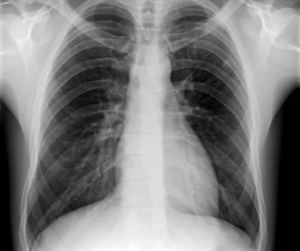 X-ray of human chest