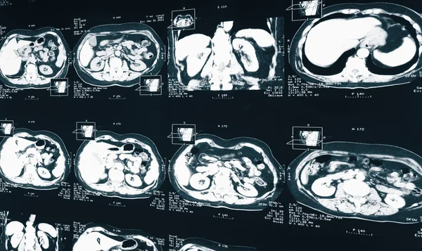 MRI. X-ray of the human kidney