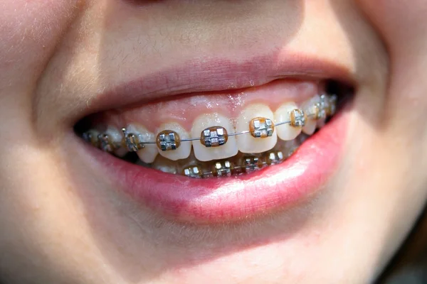 Young woman smile with bracket
