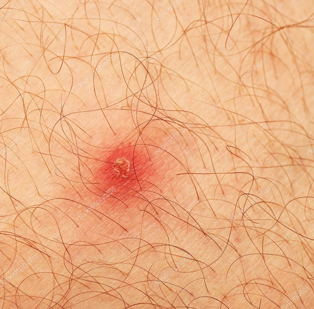 pictures of pimple on human skin macro csp9188528 search stock photos images pimple on human skin macro stock photo 169 inxti74 9890168 pictures of pimple on human skin macro csp9188528 search stock photos images pimple on human skin macro stock photo 169 inxti74 9890168