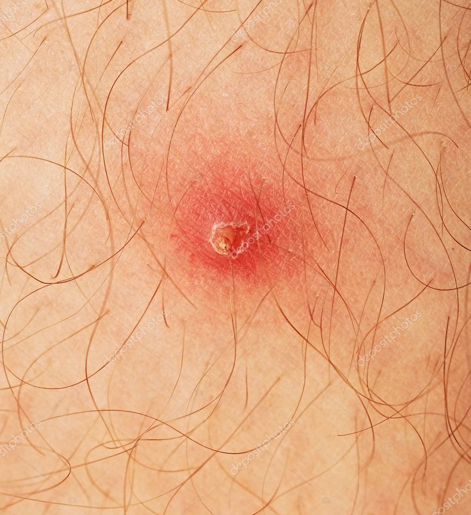 pictures of pimple on human skin macro csp9188528 search stock photos images pimple on human skin macro stock photo 169 inxti74 9890414 pictures of pimple on human skin macro csp9188528 search stock photos images pimple on human skin macro stock photo 169 inxti74 9890414