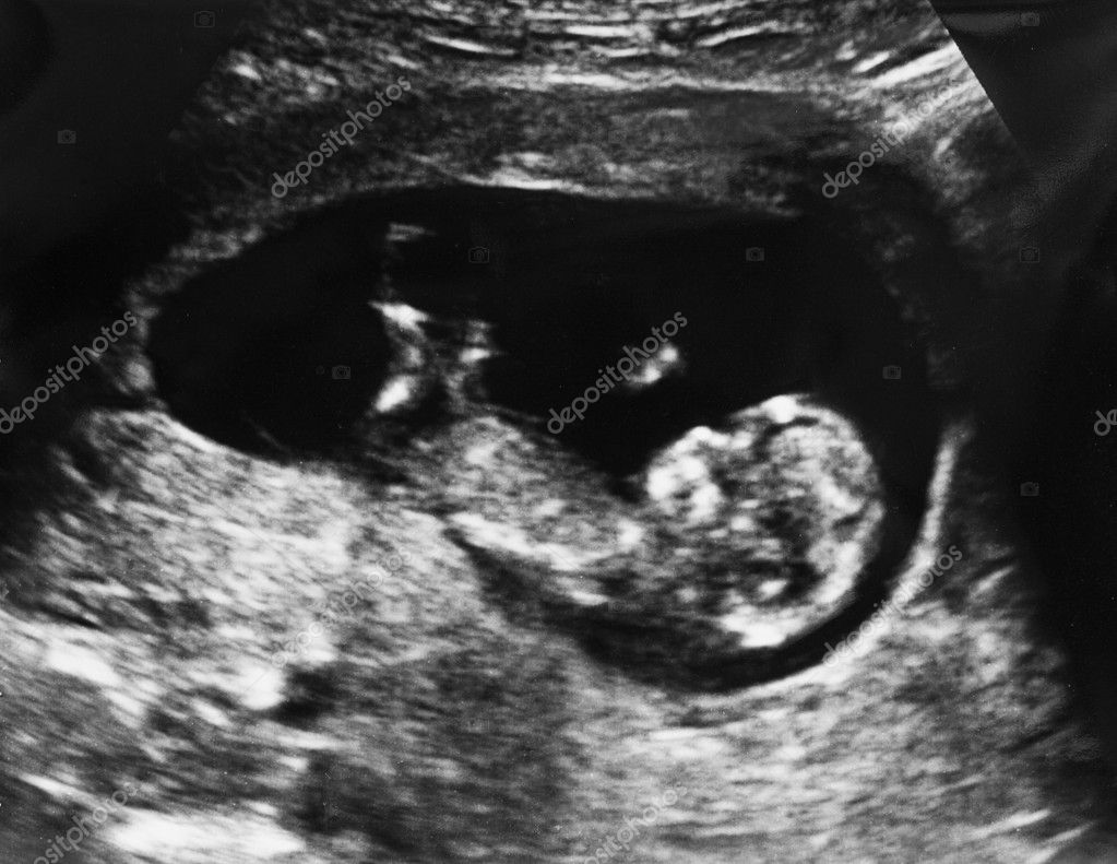 3+Months+Fetus+Size Months Completed Pregnancy Ultrasound | Search Results | PREGNANT ...