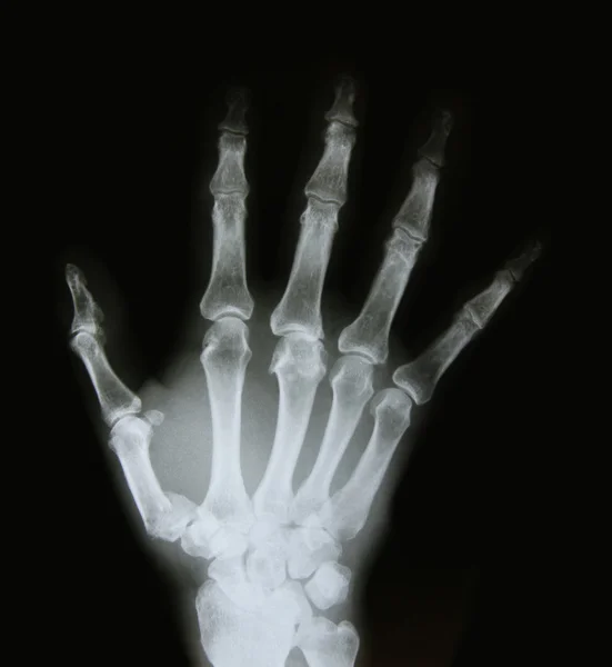 X-ray image of the bones of arm