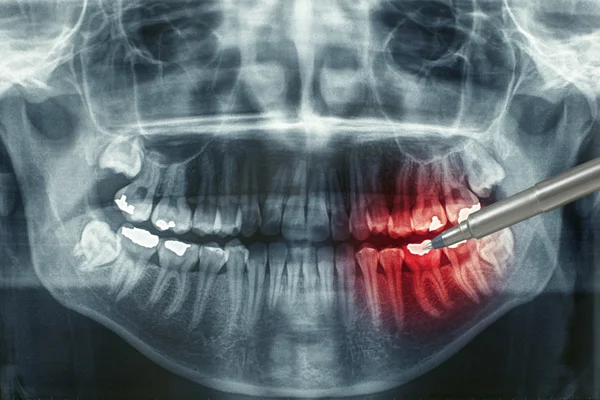Panoramic dental xray
