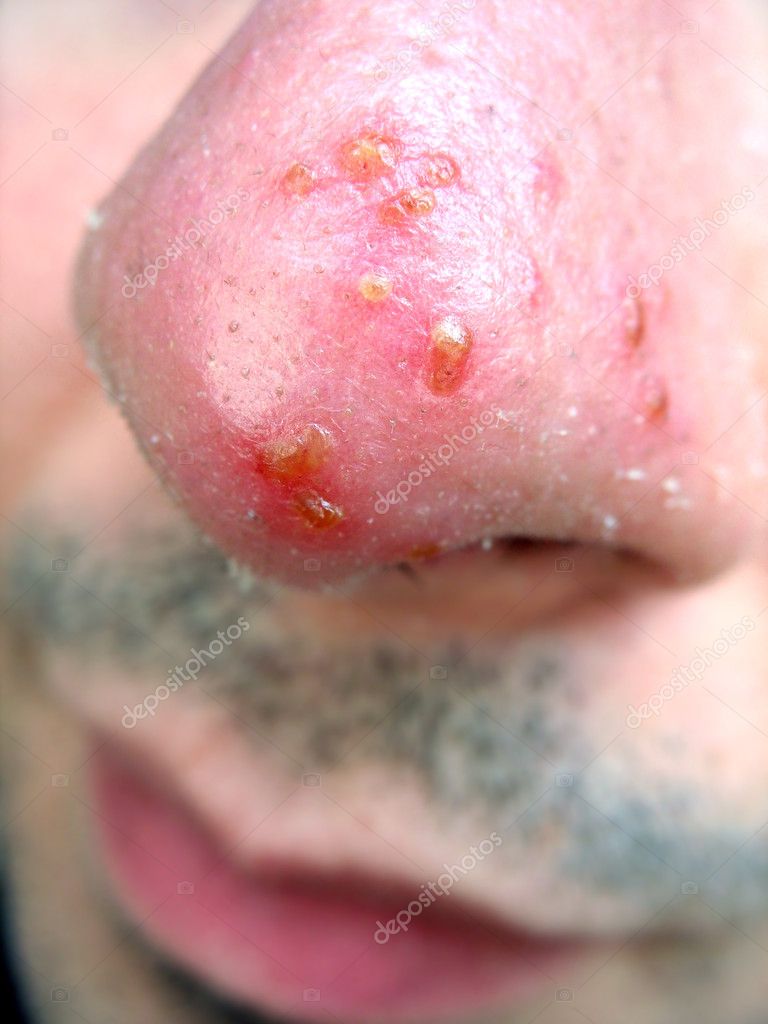 What Causes Cold Sores? Remedies, Stages, Treatment