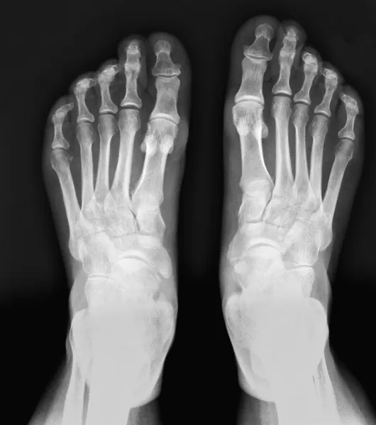 X-ray of feet
