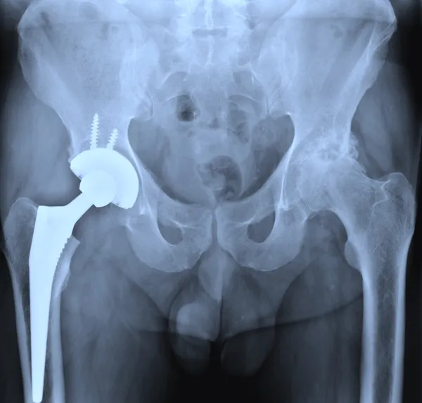 X-ray of the hip prostesis