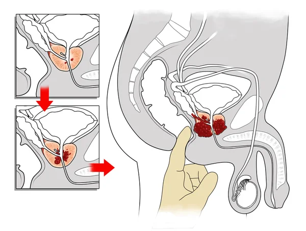 Prostate cancer