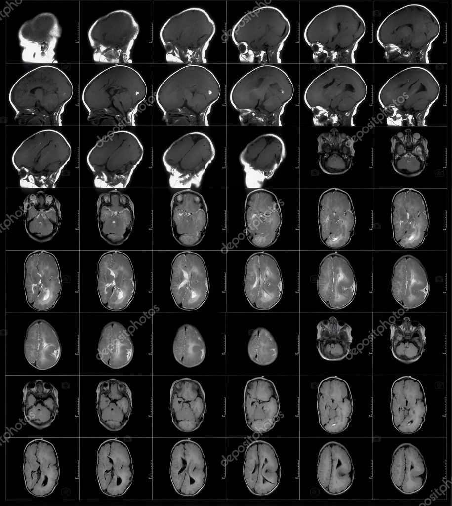 Mri On Head