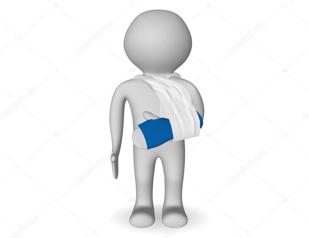 Broken arm in plaster of Paris — Stock Photo © weissdesign 10490309