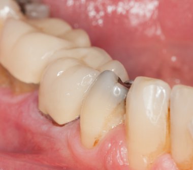 Macro image of filled teeth clipart