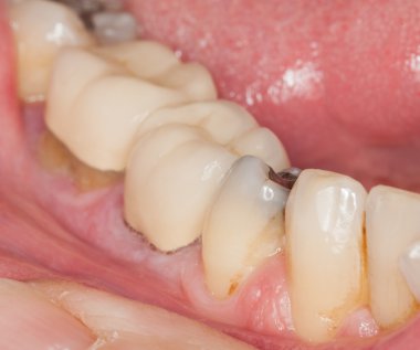 Macro image of filled teeth
