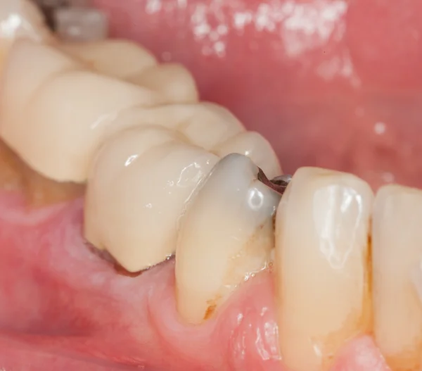 Imagem macro de dentes obturados — Fotografia de Stock