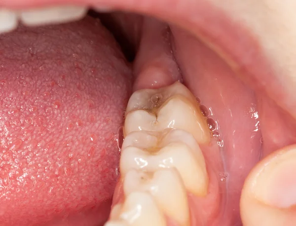 Макрозображення заповнених зубів — стокове фото