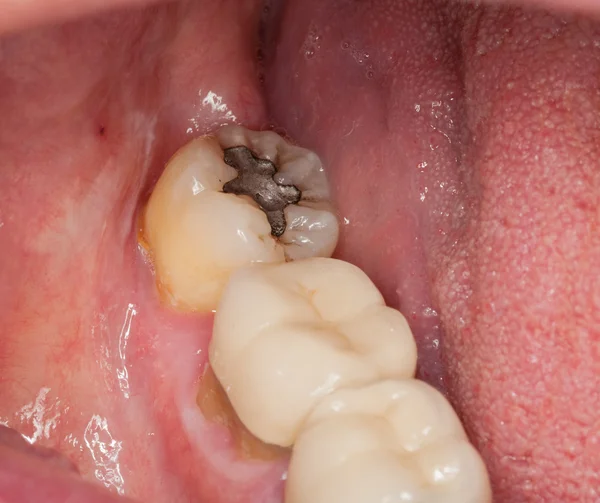 塗りつぶされた歯のマクロ画像 — ストック写真