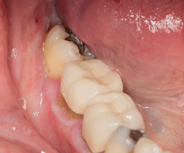 채워진된 치아의 매크로 이미지 — 스톡 사진