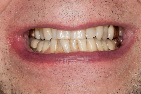 塗りつぶされた歯のマクロ画像 — ストック写真