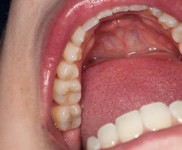 Makroaufnahme gefüllter Zähne — Stockfoto