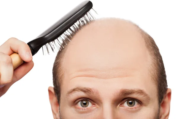 Bald man head — Stock Photo, Image