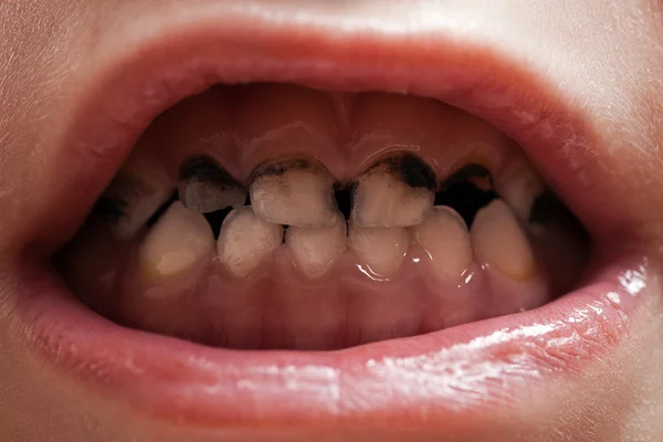 Caries teeth decay — Stock Photo, Image