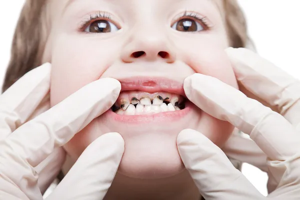 Karies tänderna förfall — Stockfoto