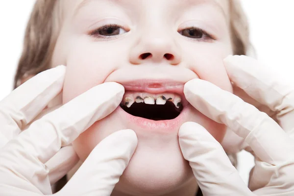 Examinando cárie cárie dentes decadência — Fotografia de Stock