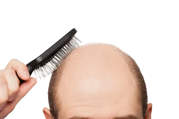 Bald man head — Stock Photo, Image
