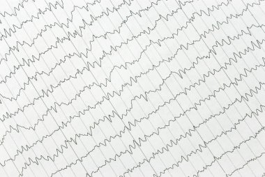 Elektrokardiyogram kalp