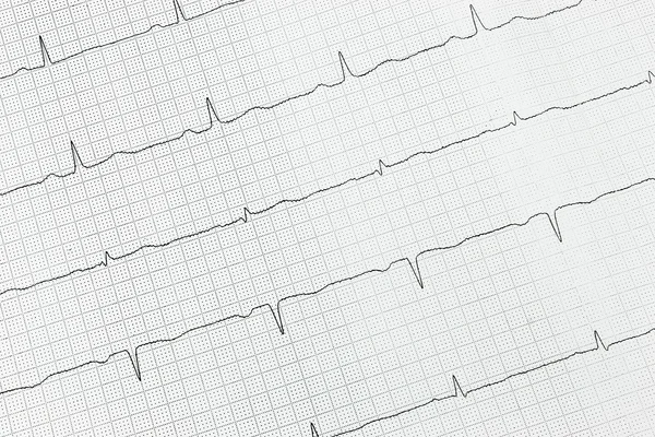 O eletrocardiograma do coração — Fotografia de Stock