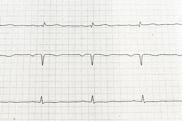 Електрокардіограма серця — стокове фото