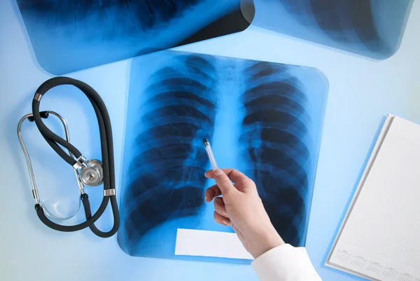 Imagen de rayos X de los pulmones —  Fotos de Stock