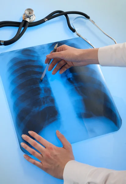 Рентгенівське зображення легенів — стокове фото