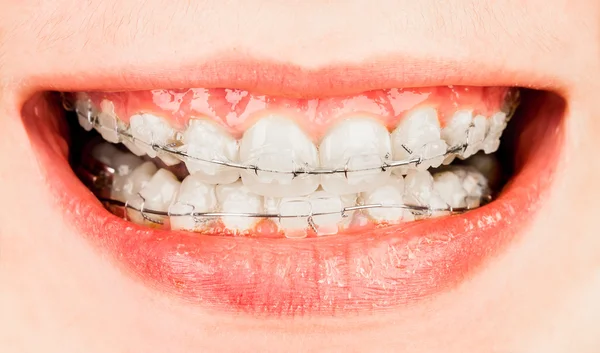 Appareils dentaires — Photo