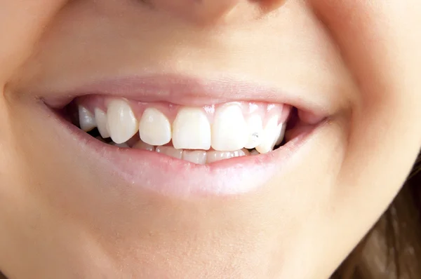 Mujer sonriente boca con cristal en los dientes . — Foto de Stock