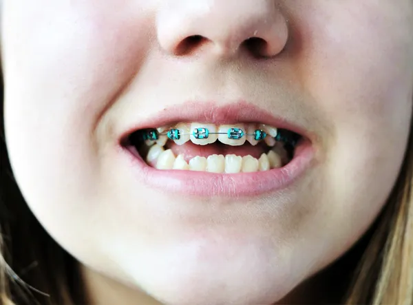 Brace pada gigi bengkok buruk — Stok Foto