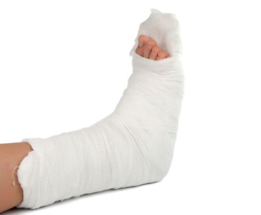 Leg in a plaster cast clipart