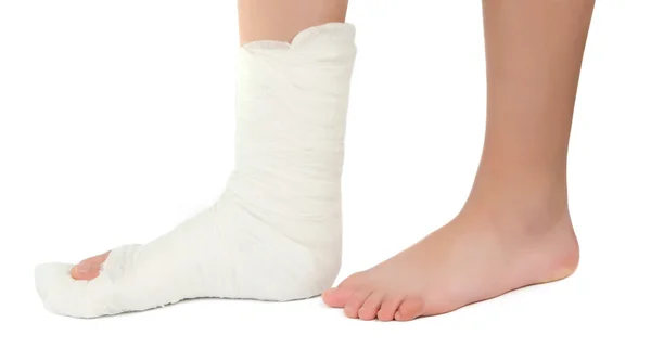 Ben i en gips avgjutning — Stockfoto