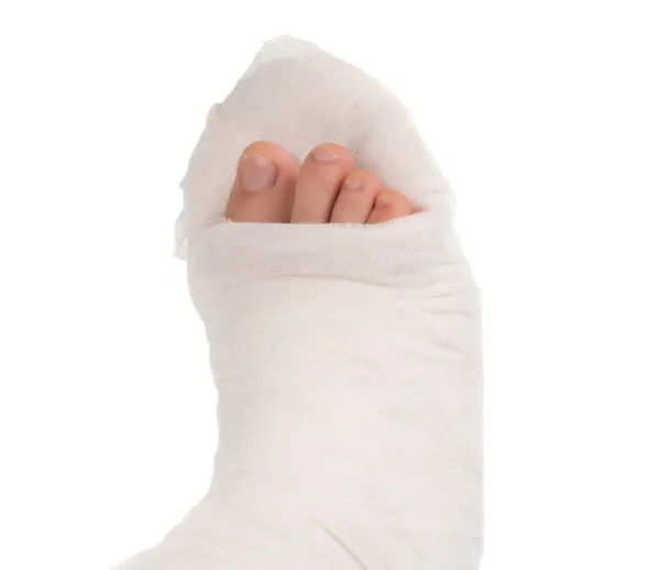 Leg in a plaster cast — Stock Photo, Image