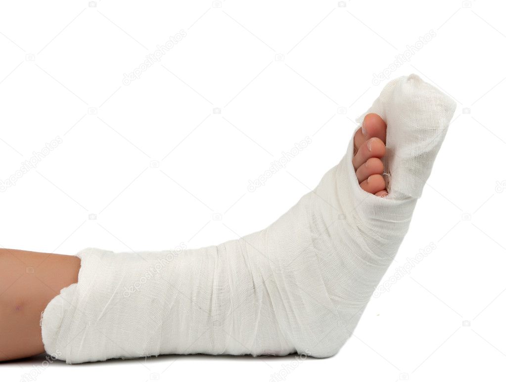 Leg in a plaster cast - Stock Photo, Image. 