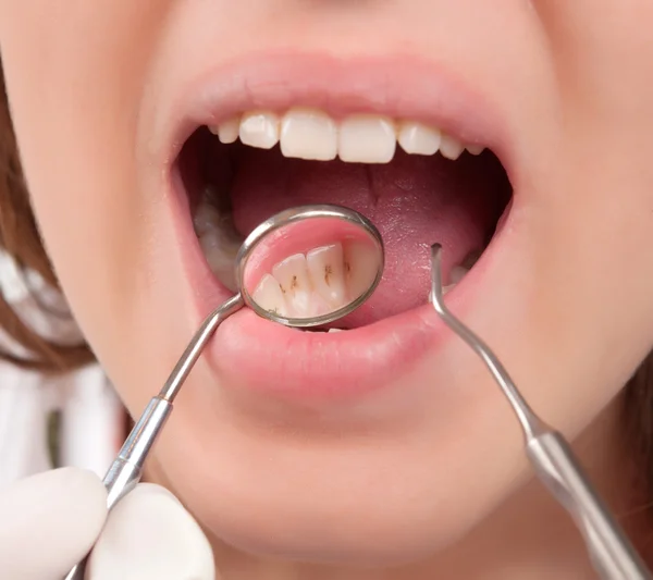 Лікування зубів — стокове фото