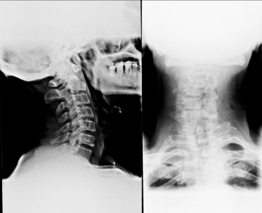 X-ray of the neck of human clipart