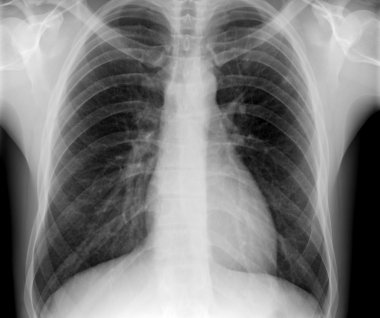 X-ray of human chest clipart