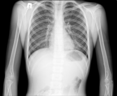 insan göğüs röntgeni