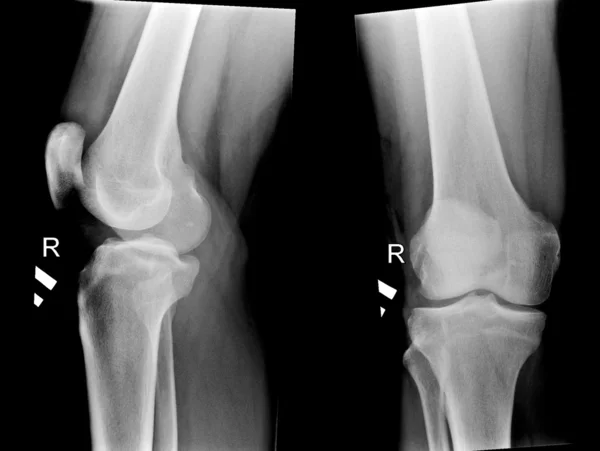 人体膝关节的 x 光照片 — 图库照片