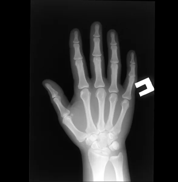 Radiografia della mano umana — Foto Stock