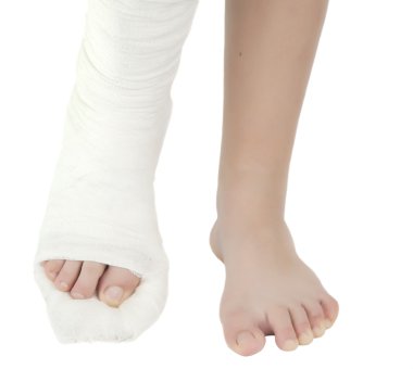 Leg in a plaster cast clipart