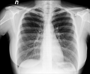 X-ray of chest clipart