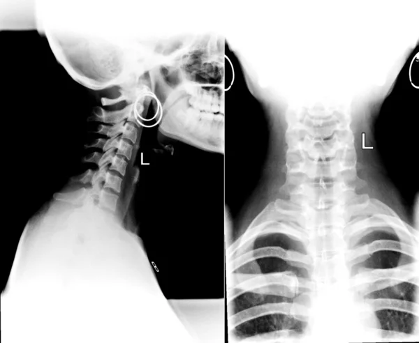 Деталь рентгеновского изображения шеи — стоковое фото