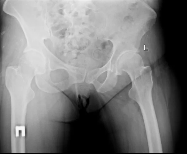 X-ray van het bekken — Stockfoto
