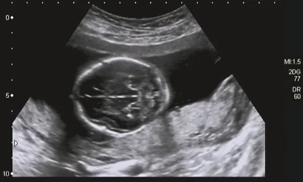 Ανάλυση υπερηχογραφικό έλεγχο του εμβρύου 4ο μήνα — Φωτογραφία Αρχείου